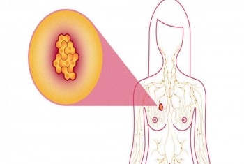 اختراق طبي في علاج سرطان الثدي بجرعة إشعاعية واحدة